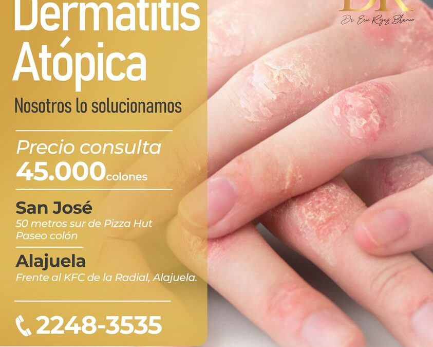 ¿Tienes dermatitis atópica?👇😉