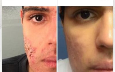 Limpiar tu rostro del acné es posible y nuestro tratamiento es la solución.