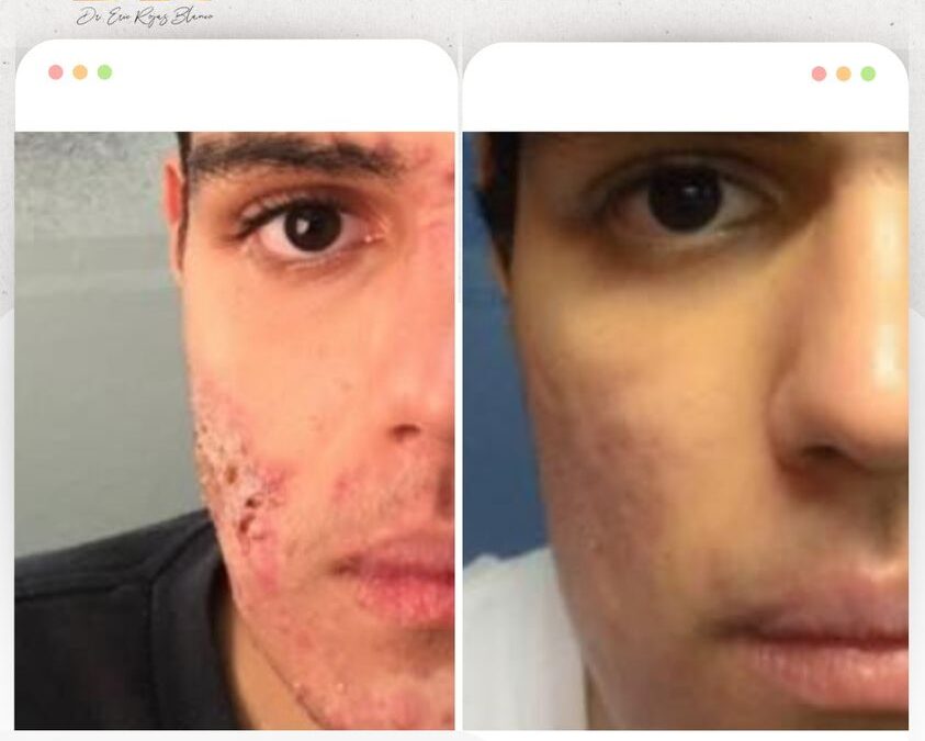Limpiar tu rostro del acné es posible y nuestro tratamiento es la solución.