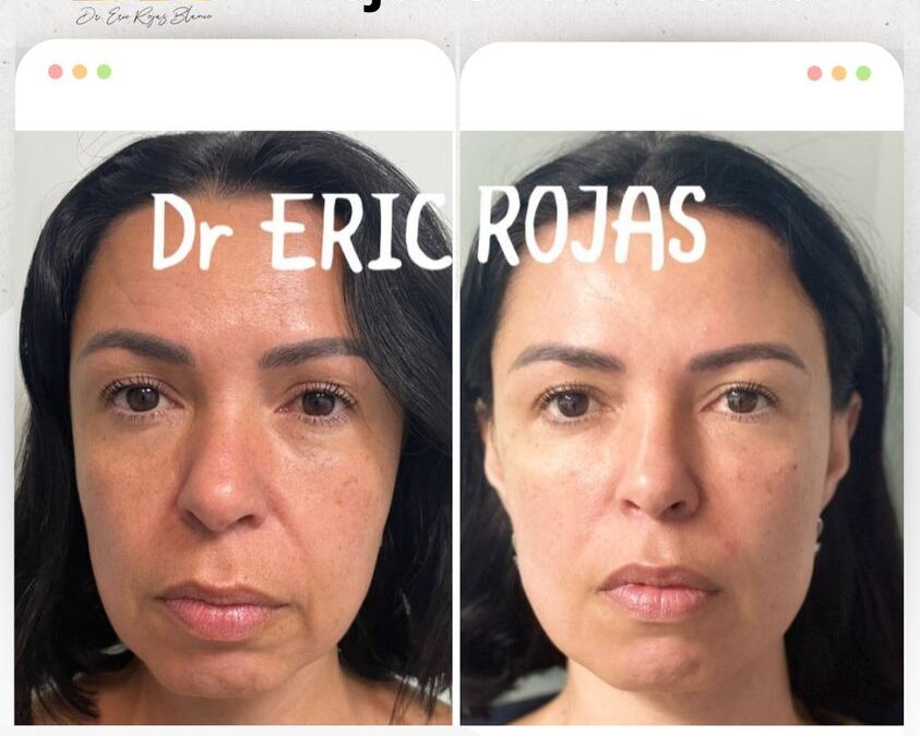 Rejuvenece tu rostro con esta increíble técnica.👇😉