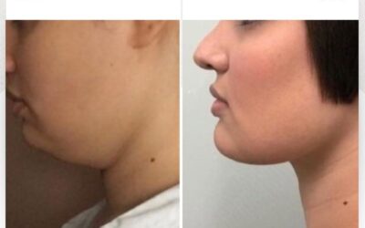 Reducción de papada con SLIM LÁSER.