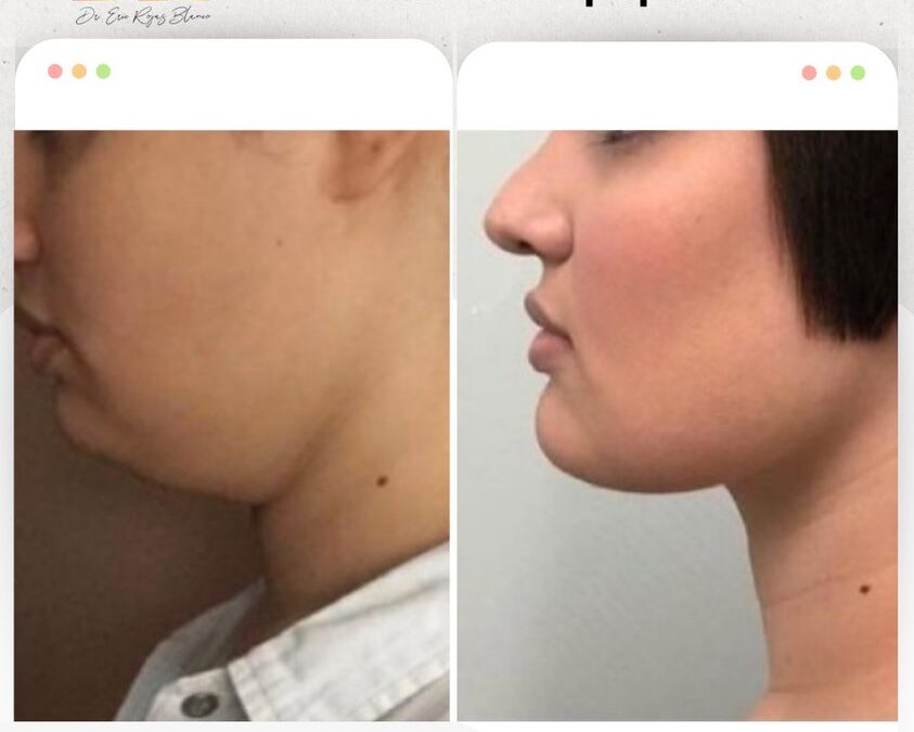 Reducción de papada con SLIM LÁSER.