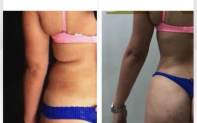 Estos son los cambios que genera el Slim Láser.