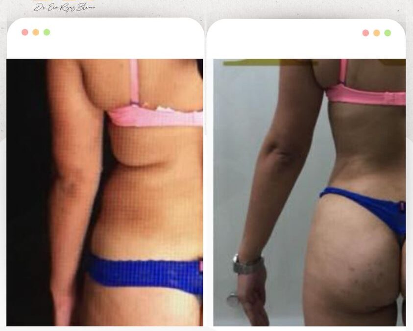 Estos son los cambios que genera el Slim Láser.