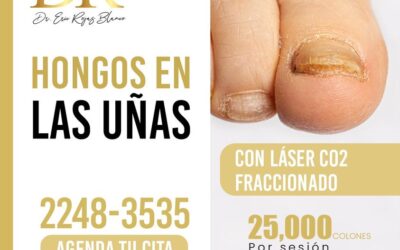 Tratamiento para hongos en las uñas.