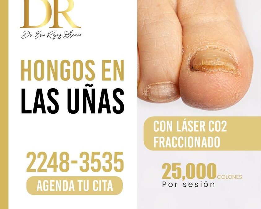 Tratamiento para hongos en las uñas.