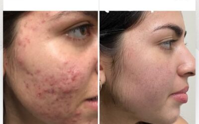 Limpia tu rostro con el mejor tratamiento.