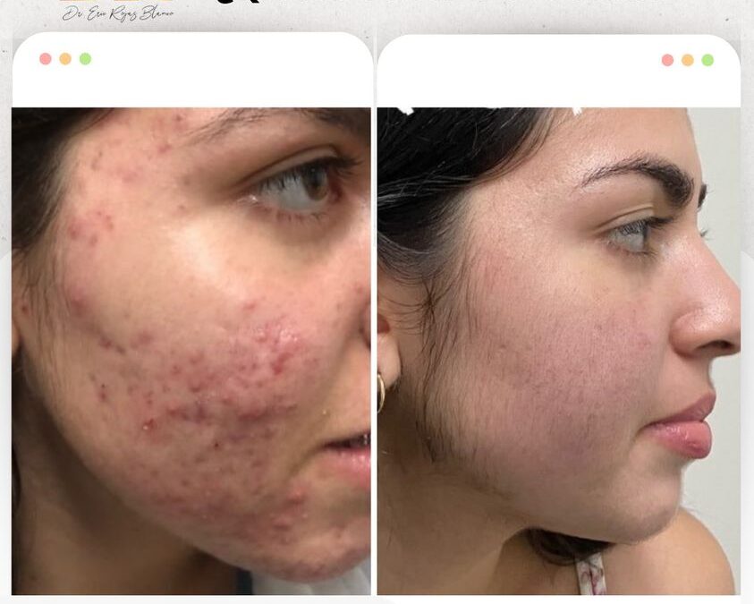 Limpia tu rostro con el mejor tratamiento.