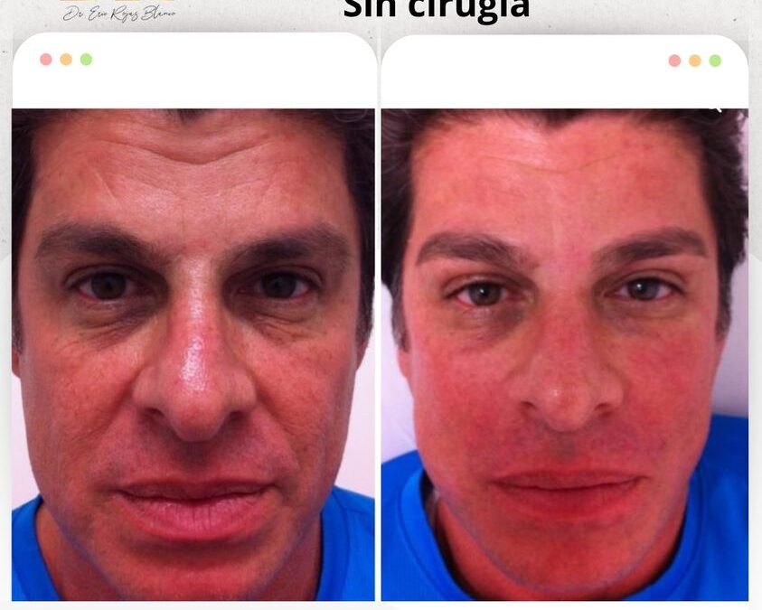 Rejuvenecimiento sin cirugía.