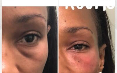 Rejuvenece tu rostro con la mejor técnica del país.