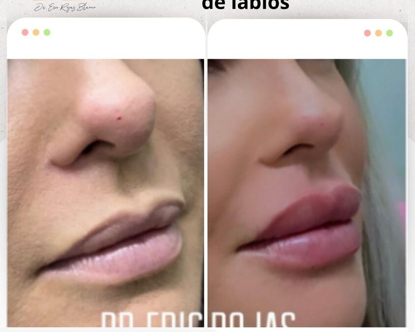 Relleno de labios.