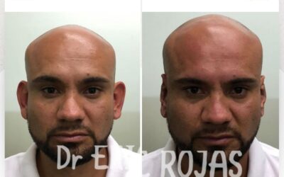 Corrección de orejas con la Dermo Otoplastía.