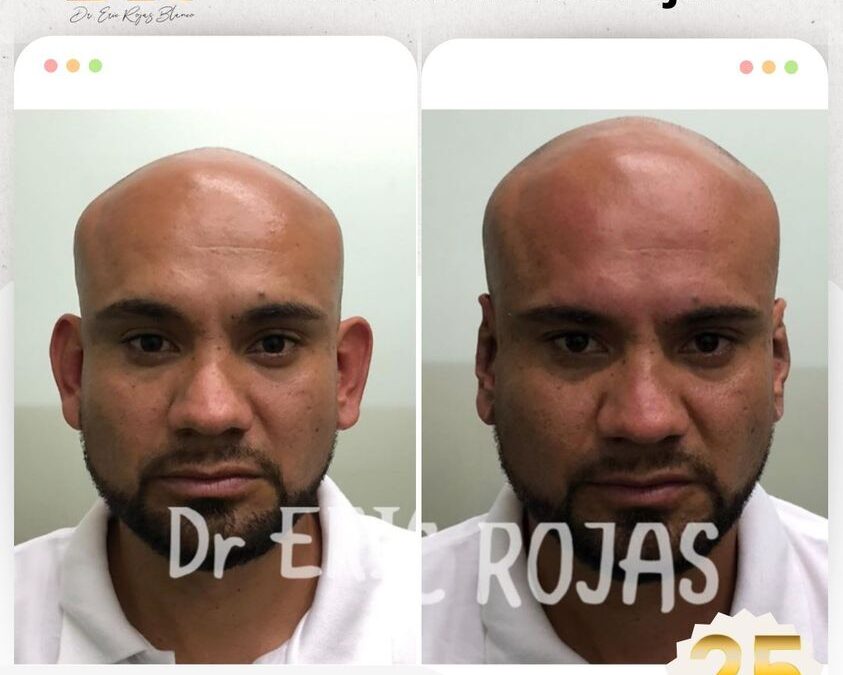 Corrección de orejas con la Dermo Otoplastía.