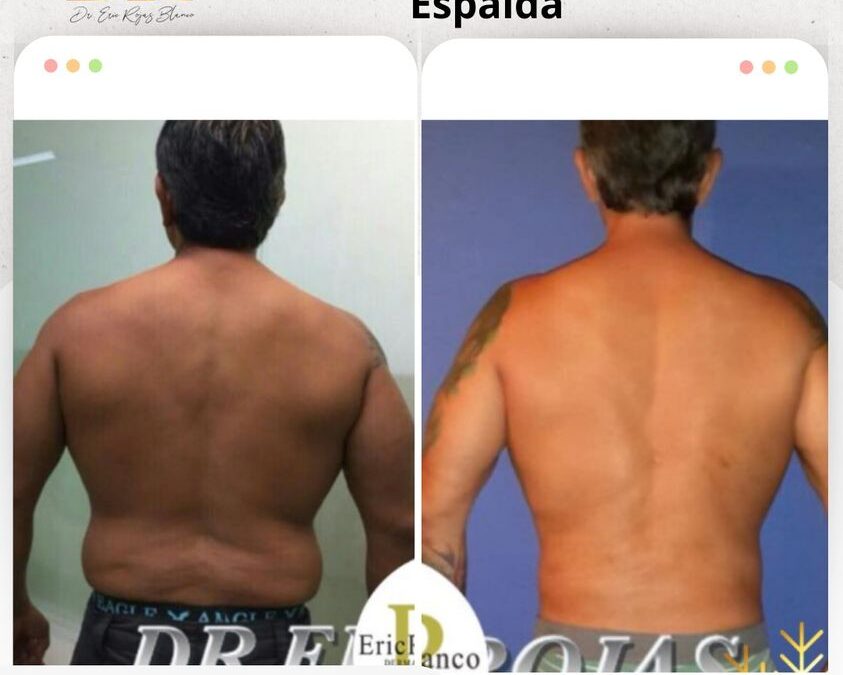 Slim Láser espalda, cambios increíbles. 👇😉