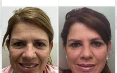 Mantén tu piel radiante con la mejor técnica del país, luce joven y saludable con nuestro rejuvenecimiento facial.