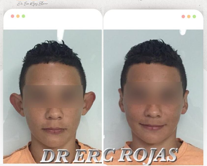 Dermo-Otoplastía en $899 USD por este mes de febrero.