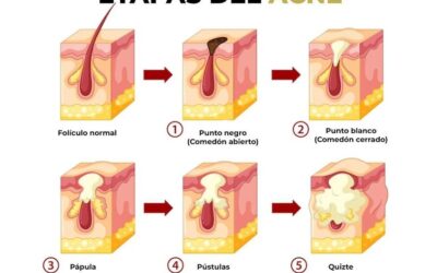 Estas son las etapas del acné, cuida tu rostro y acude a nosotros para brindarte una solución.