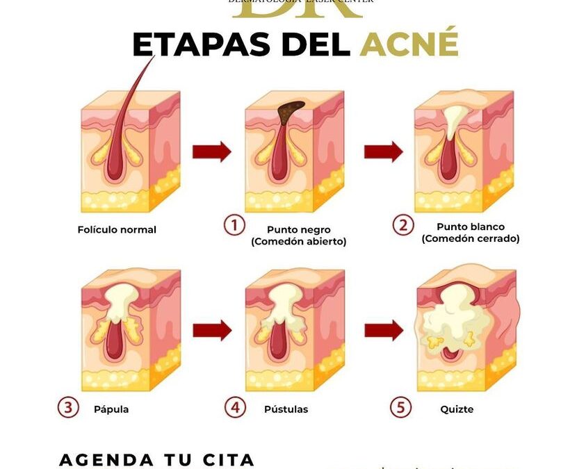 Estas son las etapas del acné, cuida tu rostro y acude a nosotros para brindarte una solución.