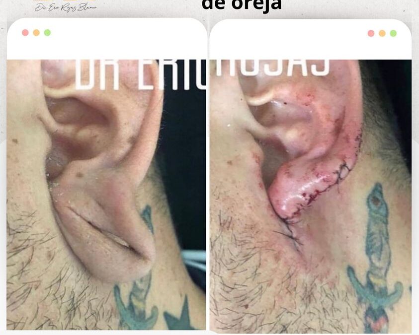 Reconstrucción de lóbulo de oreja.
