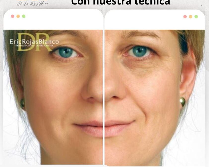 Mantén tu piel radiante con la mejor técnica del país, luce joven y saludable con nuestro rejuvenecimiento faical.