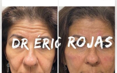 Rejuvenece tu rostro con nuestra técnica.