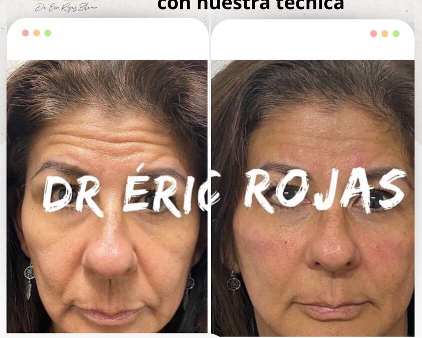 Rejuvenece tu rostro con nuestra técnica.