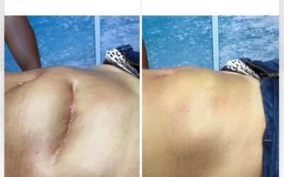 Solución de cicatriz en abdomen.