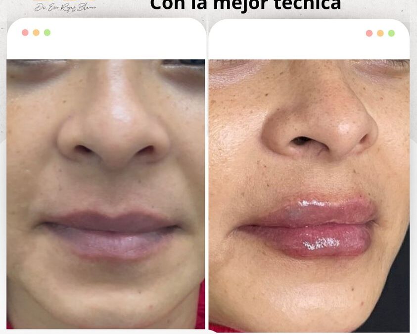 Relleno de labios con nuestra técnica única.