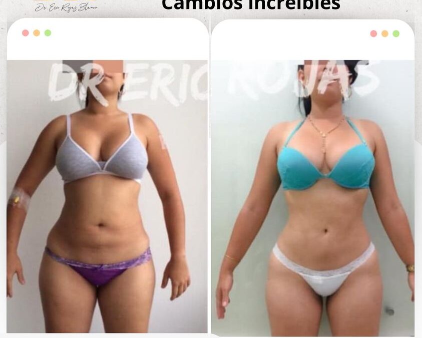 Slim Láser, regálate tu cambio.