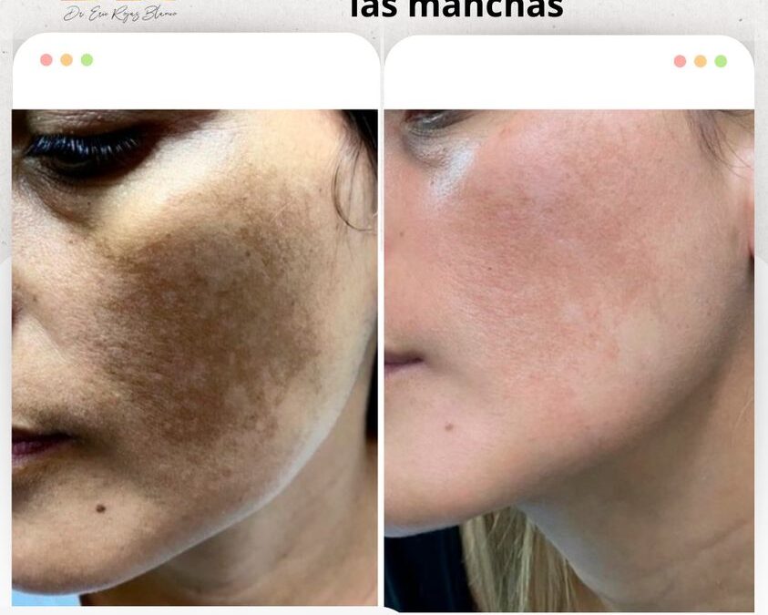 Elimina las manchas de tu rostro, con nuestro increíble procedimiento