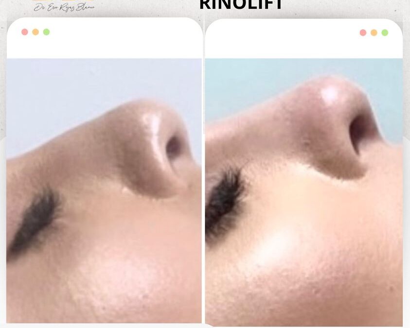 Rinolift, corrigiendo con la mejor técnica del país.