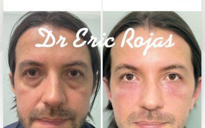 Rejuvenecimiento facial con nuestra técnica