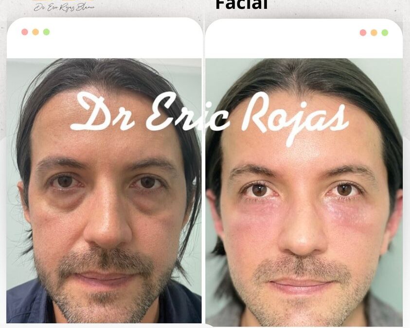 Rejuvenecimiento facial con nuestra técnica