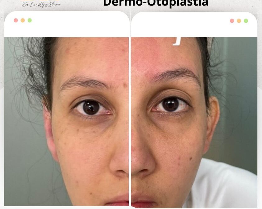 Dermo-Otoplastía para todos.