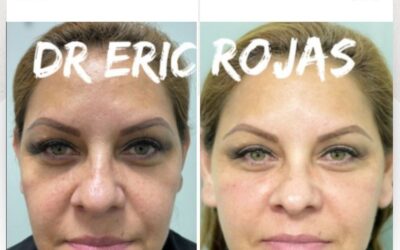 Rejuvenece tu rostro con la mejor técnica.