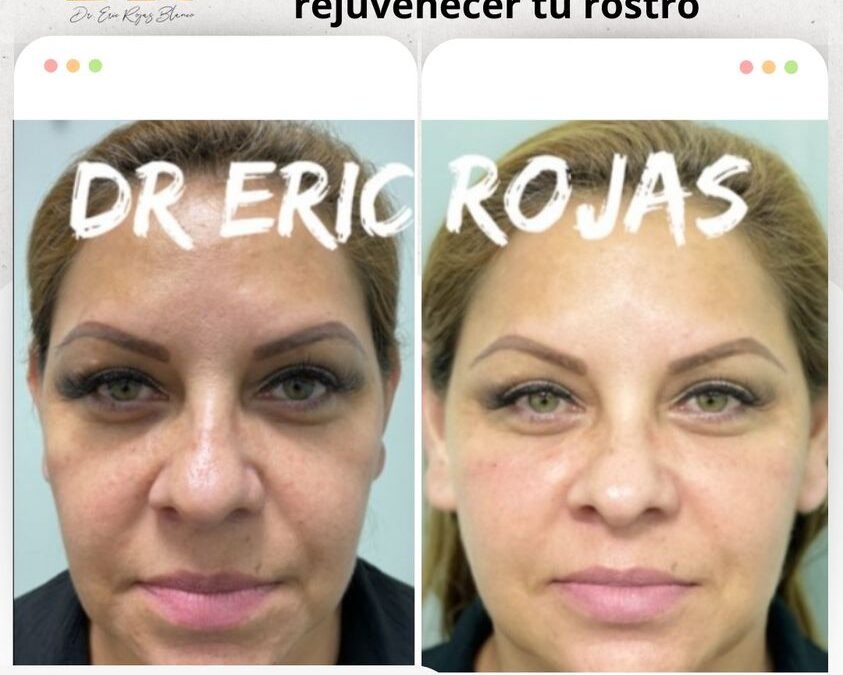 Rejuvenece tu rostro con la mejor técnica.