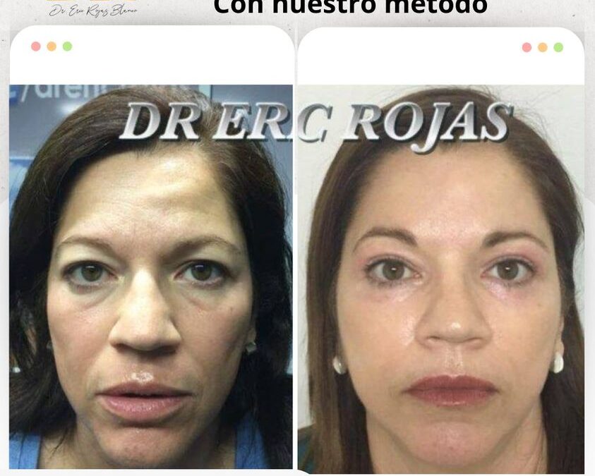 Rejuvenecimiento facial sin cirugía, visítanos.