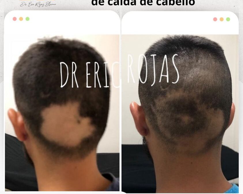 La Caída de cabello tiene solución con nosotros.