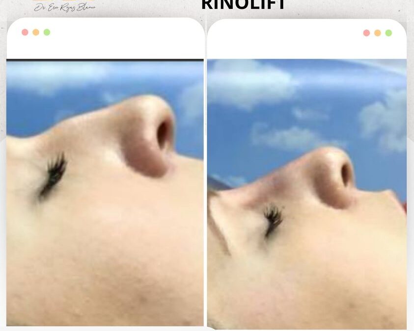 Rinolift, la mejor manera de mejorar tu perfil.