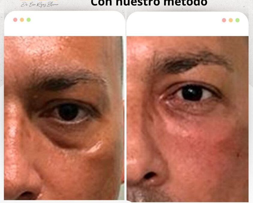 Adios a las ojeras con nuestro método, ¿Ya agendaste tu cita?