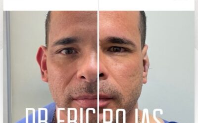 Corrección de orejas con la dermo otoplastía.