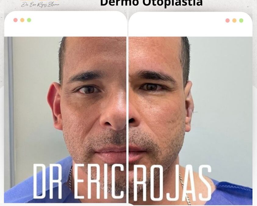 Corrección de orejas con la dermo otoplastía.