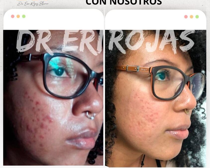 Elimina el acné y limpia tu rostro.