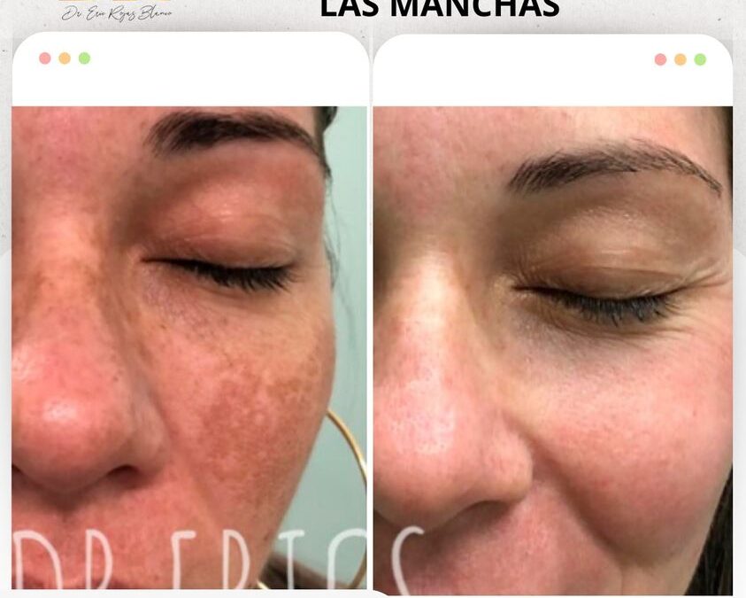 Limpia tu rostro de las manchas