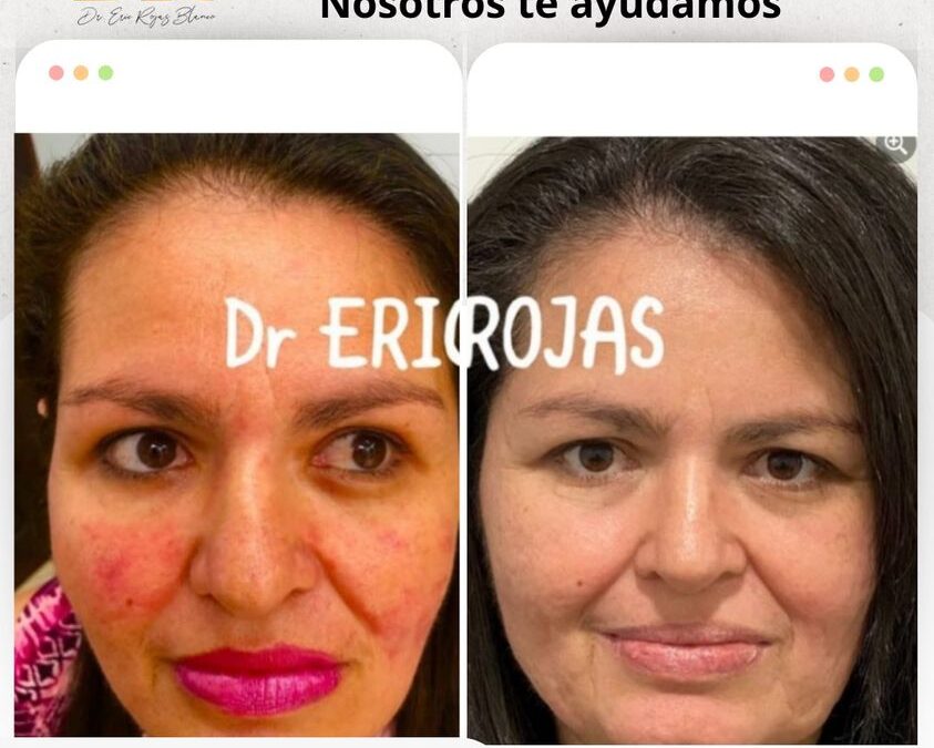 La rosacea si se cura