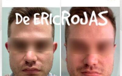 Corrección de orejas Dermo Otoplastía.👇😉