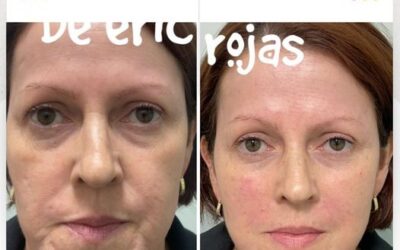 Rejuvenece tu rostro con la mejor técnica del país.