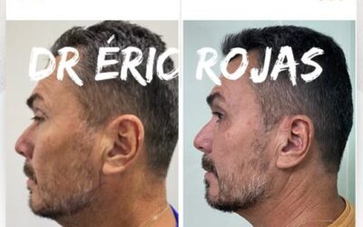 Contamos con los mejores métodos para rejuvenecer tu rostro.