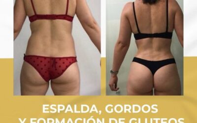¡Excelente paquete de Slim láser!