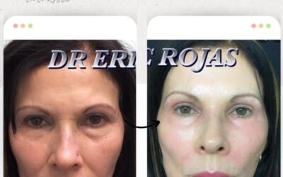 Rejuvenece tu rostro con las mejores técnicas.